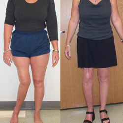 patient with tibial deformity